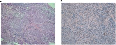 A good response to anti-PD-1 monoclonal antibody plus SBRT in a patient with PD-L1-negative recurrent advanced esophageal cancer: a long-term follow-up case report of a possible abscopal effect